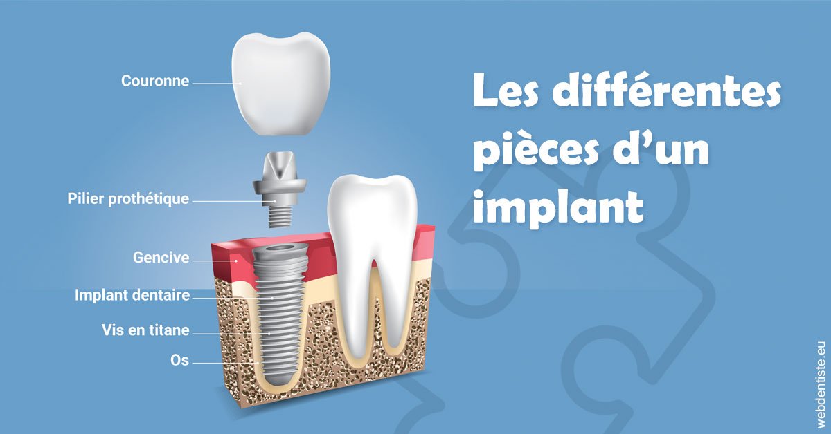 https://www.docteurfournier.fr/Les différentes pièces d’un implant 1